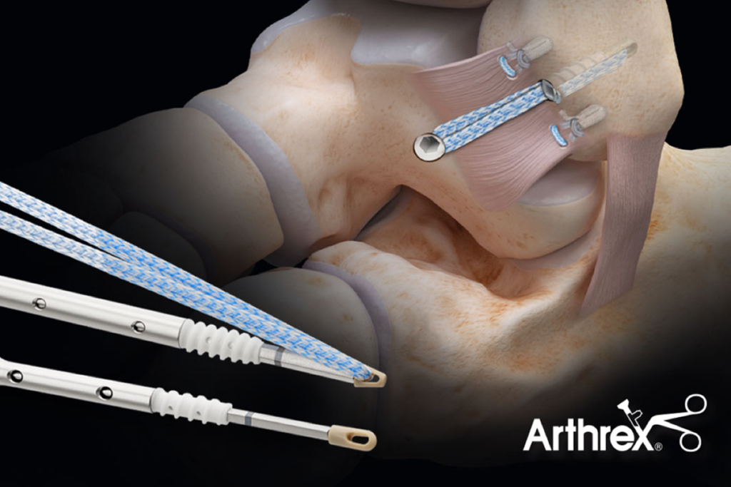 clinical evidence supporting InternalBrace  Arthrex