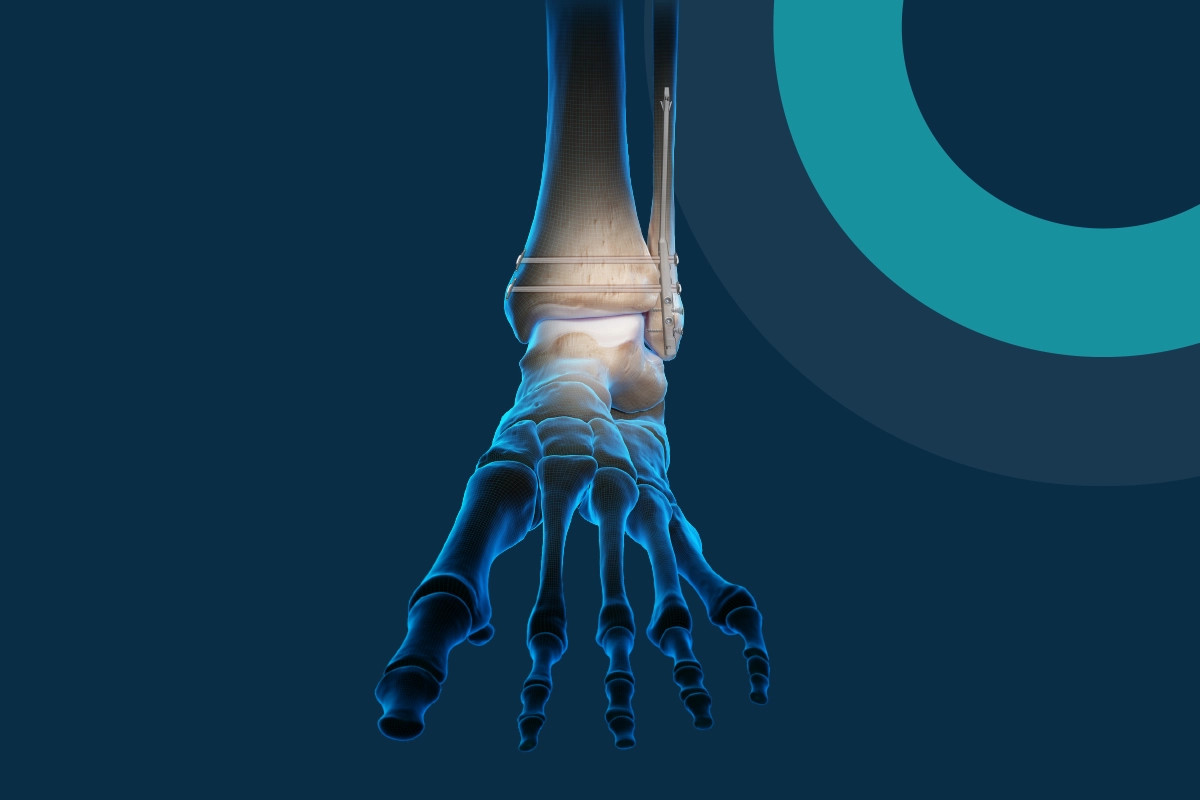 Patient's Guide to Ankle Fracture Surgery