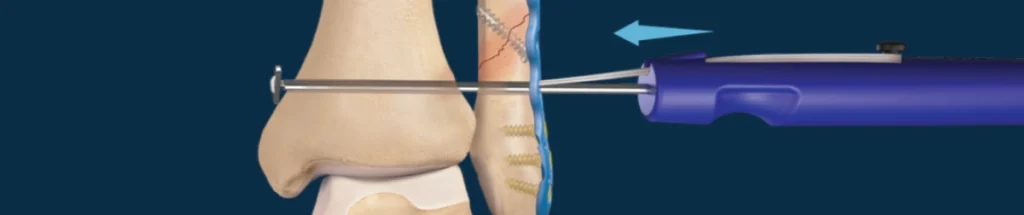 TightRope Fixation for the Syndesmosis