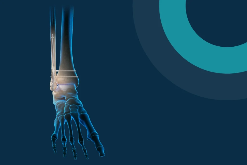 When both are used together in ankle fracture surgery